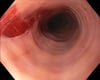 Déchirure post-dilatation