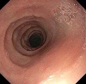 Rings and Strictures in Eosinophilic Esophagitis
