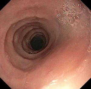Anelli e stenosi nell'esofagite eosinofila