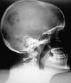 Granuloma eosinófilo del cráneo