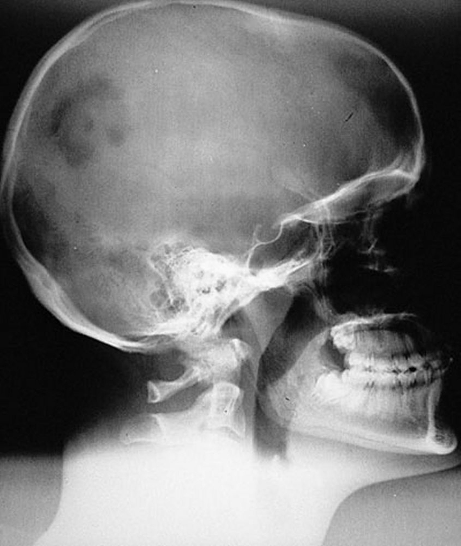 Histiocitosis de células de Langerhans (Granuloma eosinofílico) del cráneo