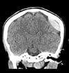 Epidural Hemorrhage (Coronal CT)