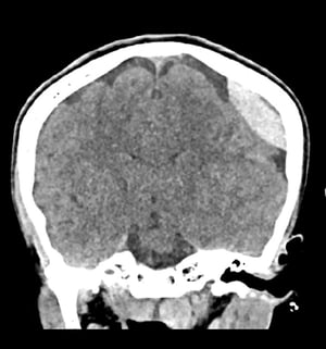 Hémorragie épidurale (TDM coronale)