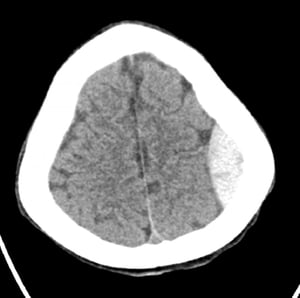 Hemorragia epidural (TC axial)