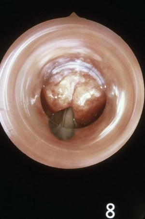 Epiglottite