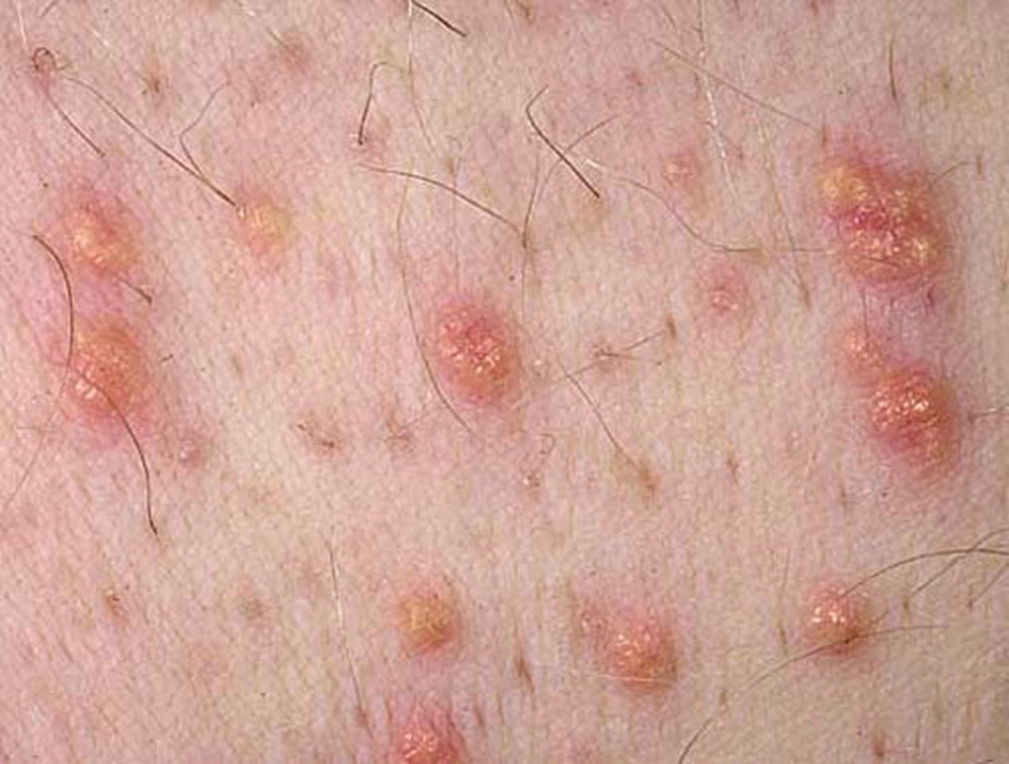 Eruptive Xanthoma (Skin)