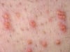 Xantoma eruptivo (piel)