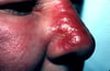 Erysipelas (Face)