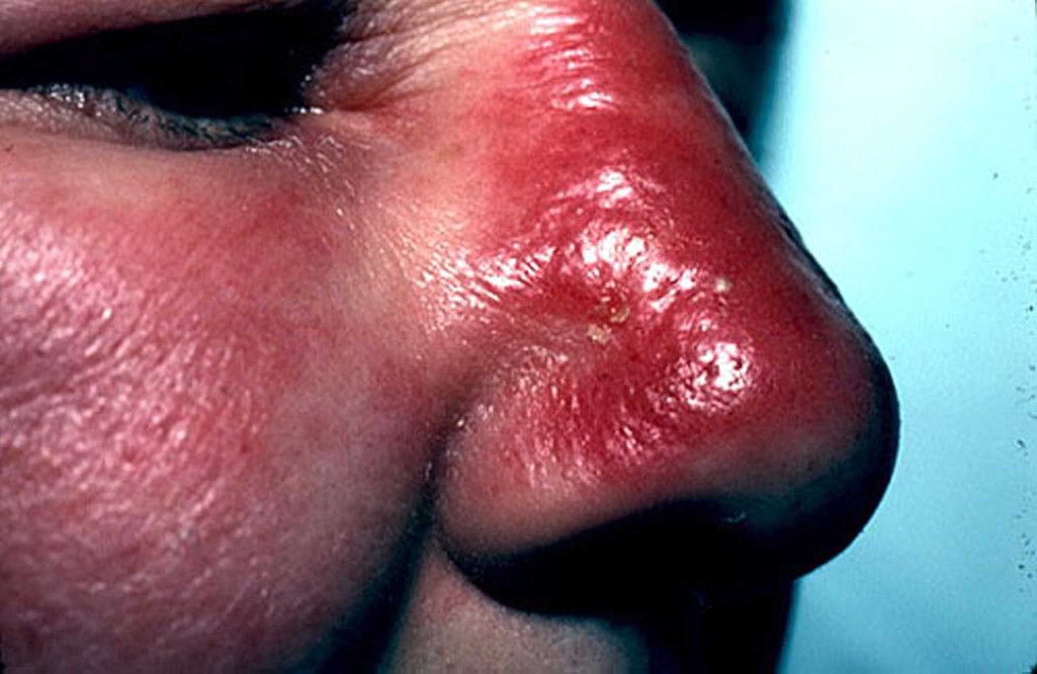 Erysipelas (Face)