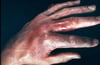 Erysipeloid