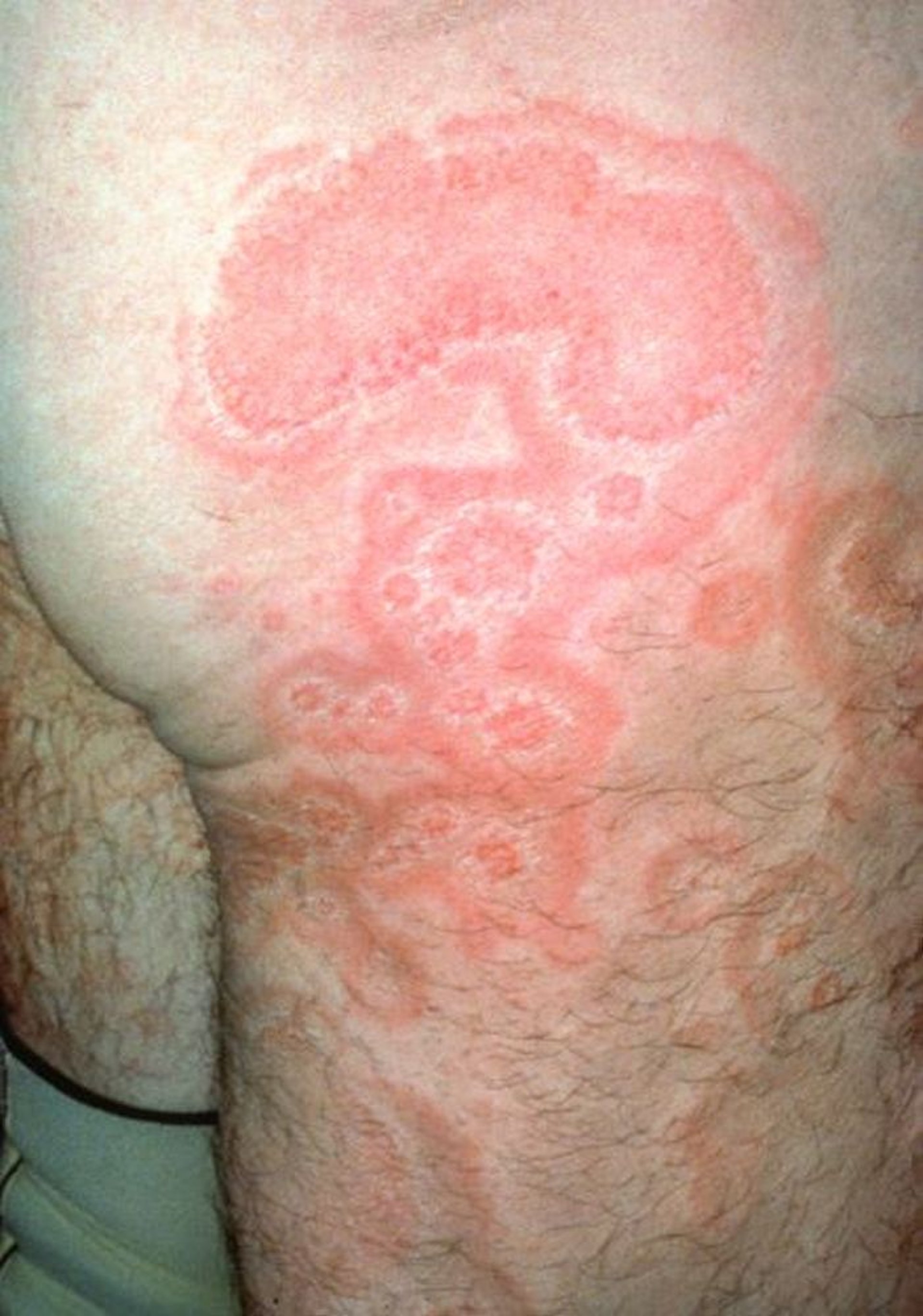Erythema anulare centrifugum