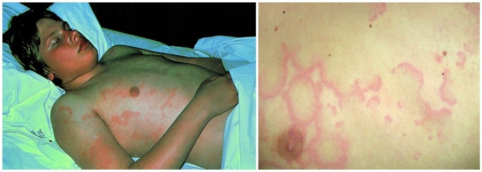 Erythema Marginatum in Rheumatic Fever