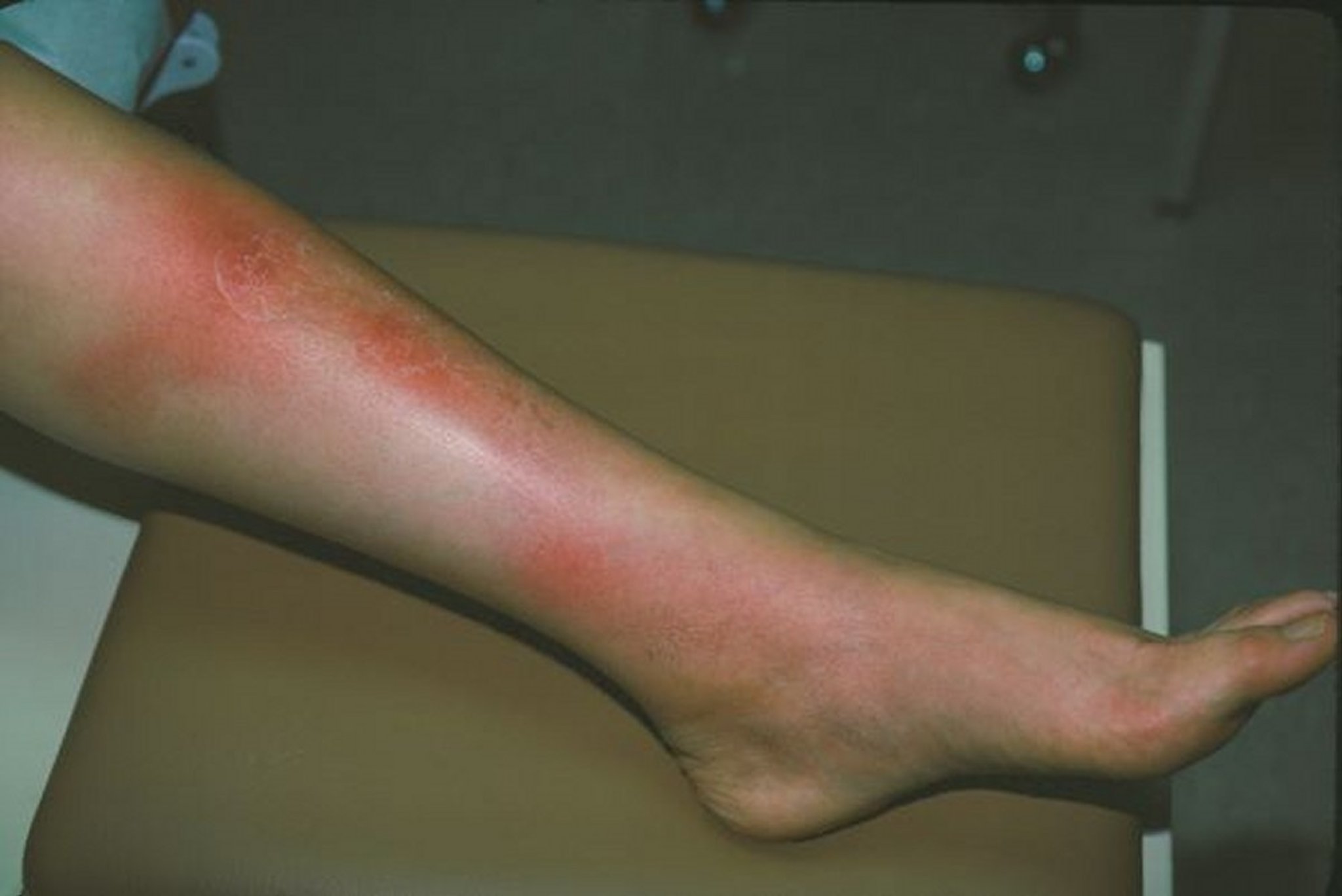 Erythema Nodosum (Leg)