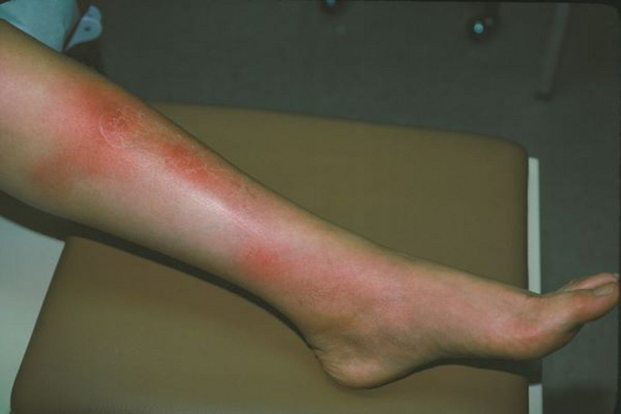 Erythema nodosum