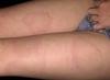 Erythema Migrans