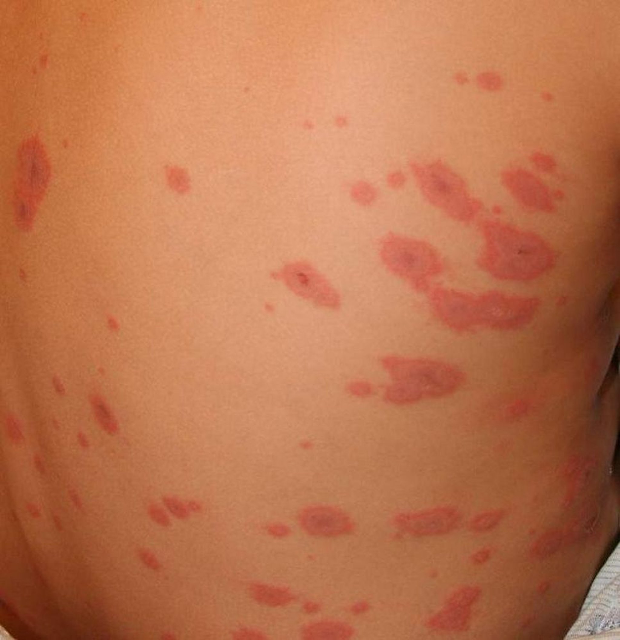 Lesiones en blanco de tiro