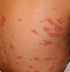 Target Lesions