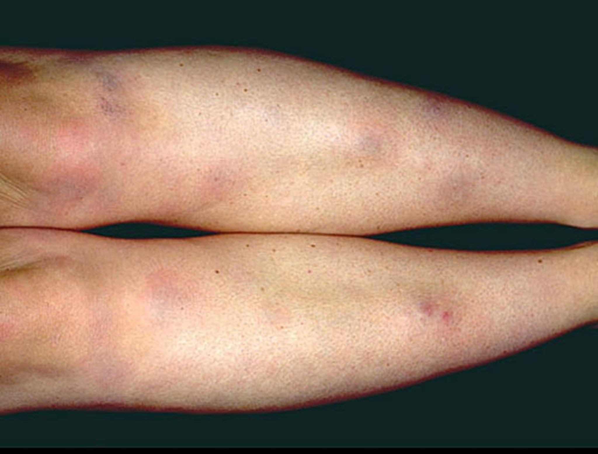 Erythema Nodosum