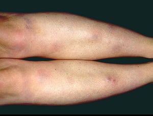 Узловатая эритема