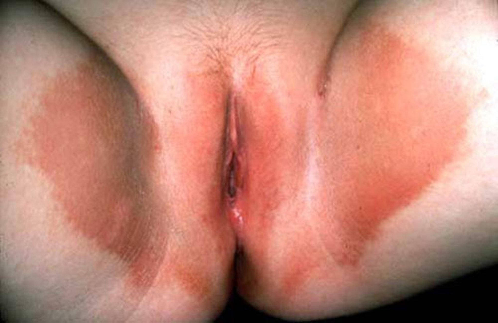 Erythrasma (Bệnh viêm da do vi khuẩn Corynebacterium minutissimum)