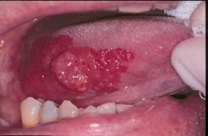 Eritroplasia y carcinoma epidermoide