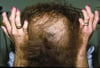 Erythropoietic Protoporphyria (Chronic Skin Changes)