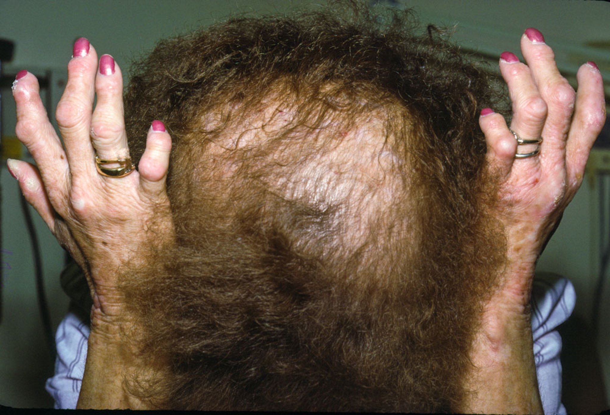 Erythropoietic Protoporphyria (Chronic Skin Changes)