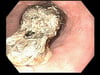 Impaction œsophagienne alimentaire (endoscopie)