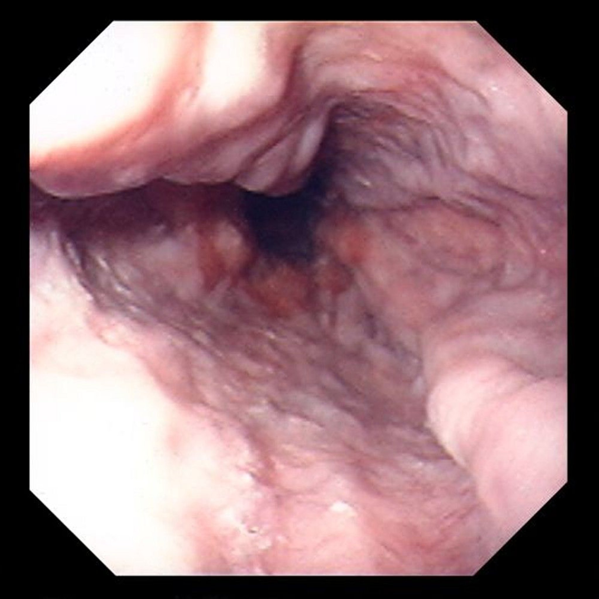 Esophageal Varices