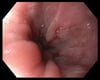 Mild Esophagitis