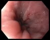 Leichte Ösophagitis
