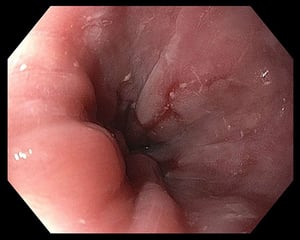 轻度食管炎
