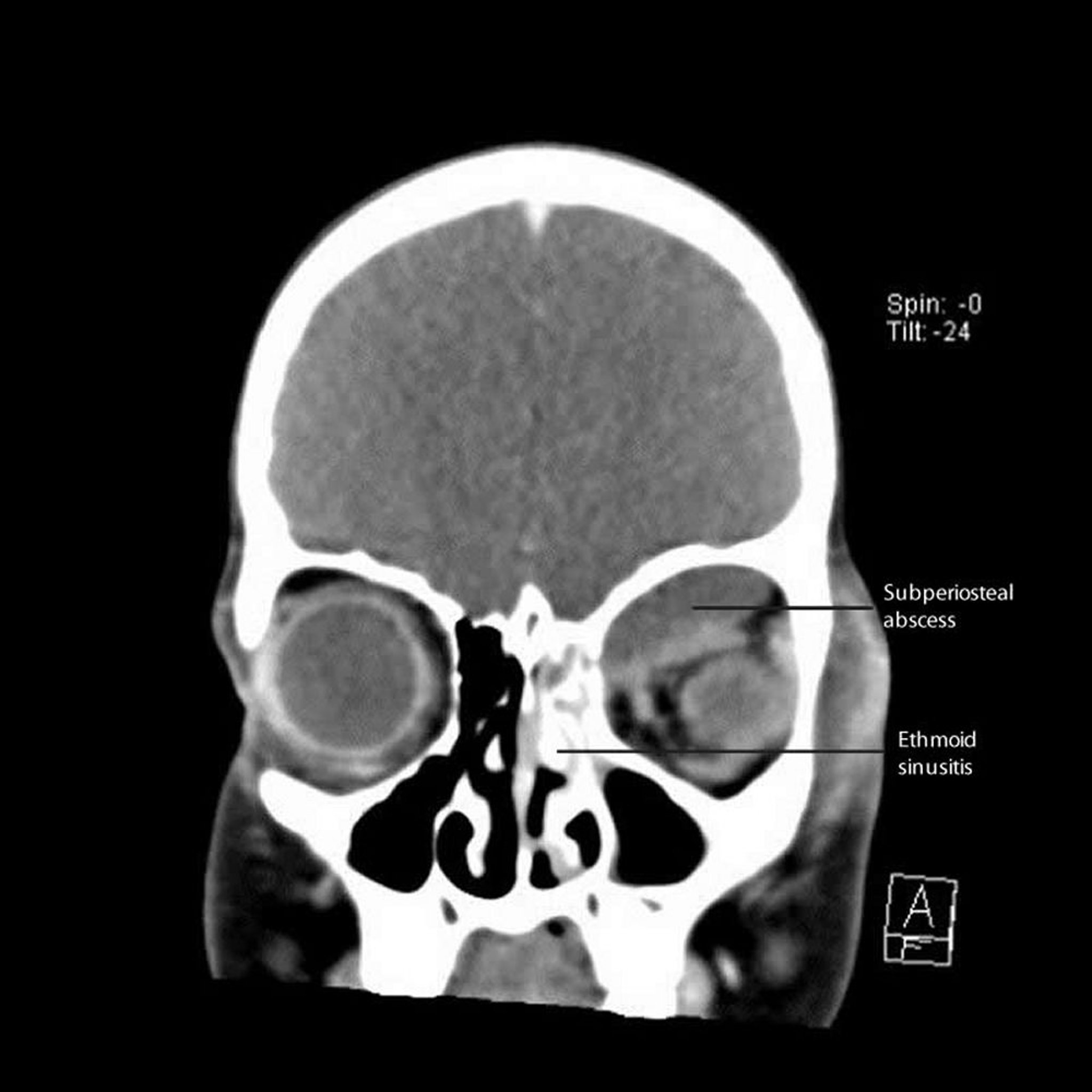 Sinusitis ethmoidalis mit subperiostalem Abszess