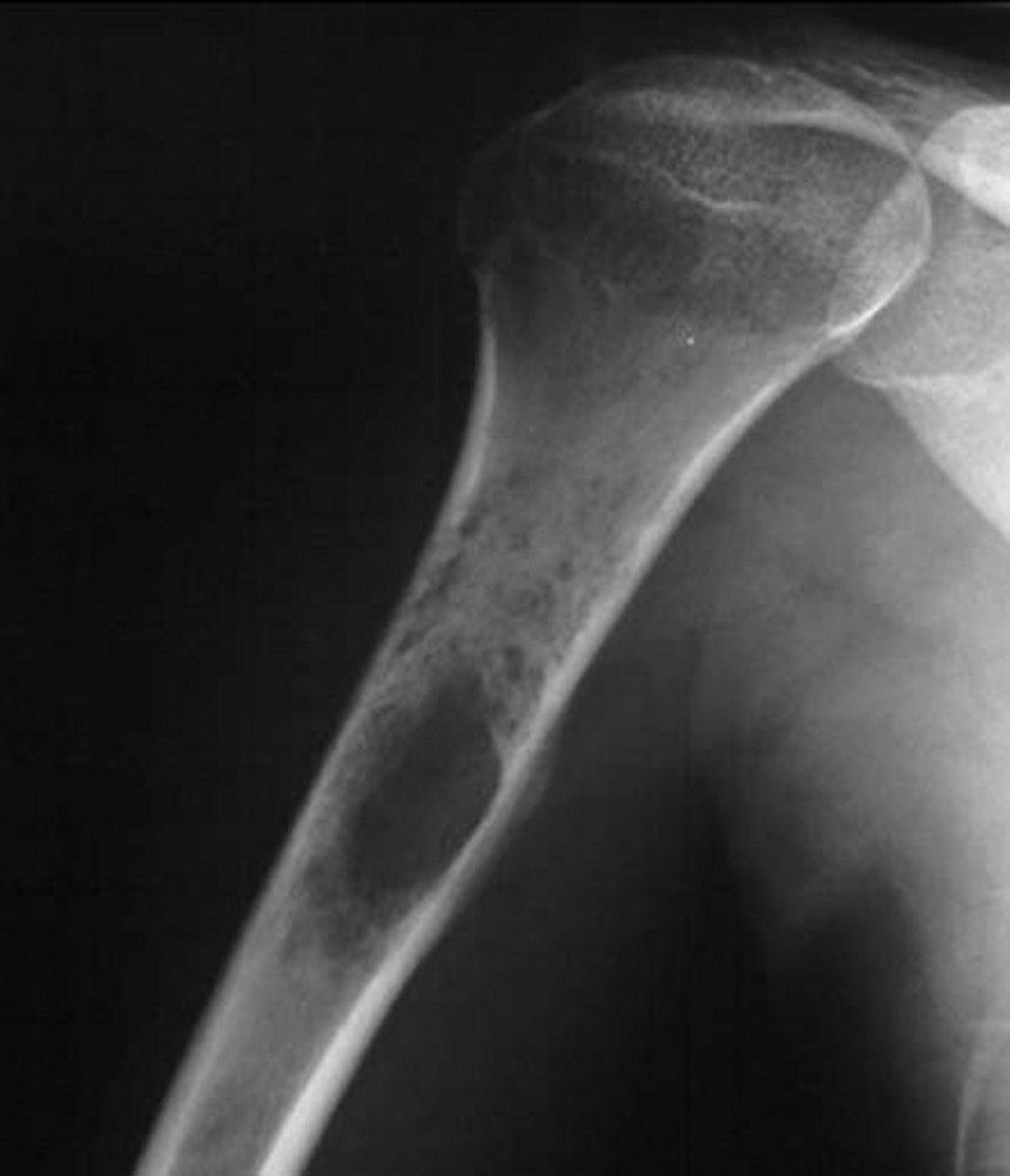 Ewing Sarcoma of Bone