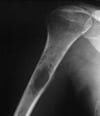 Sarcoma de Ewing óseo