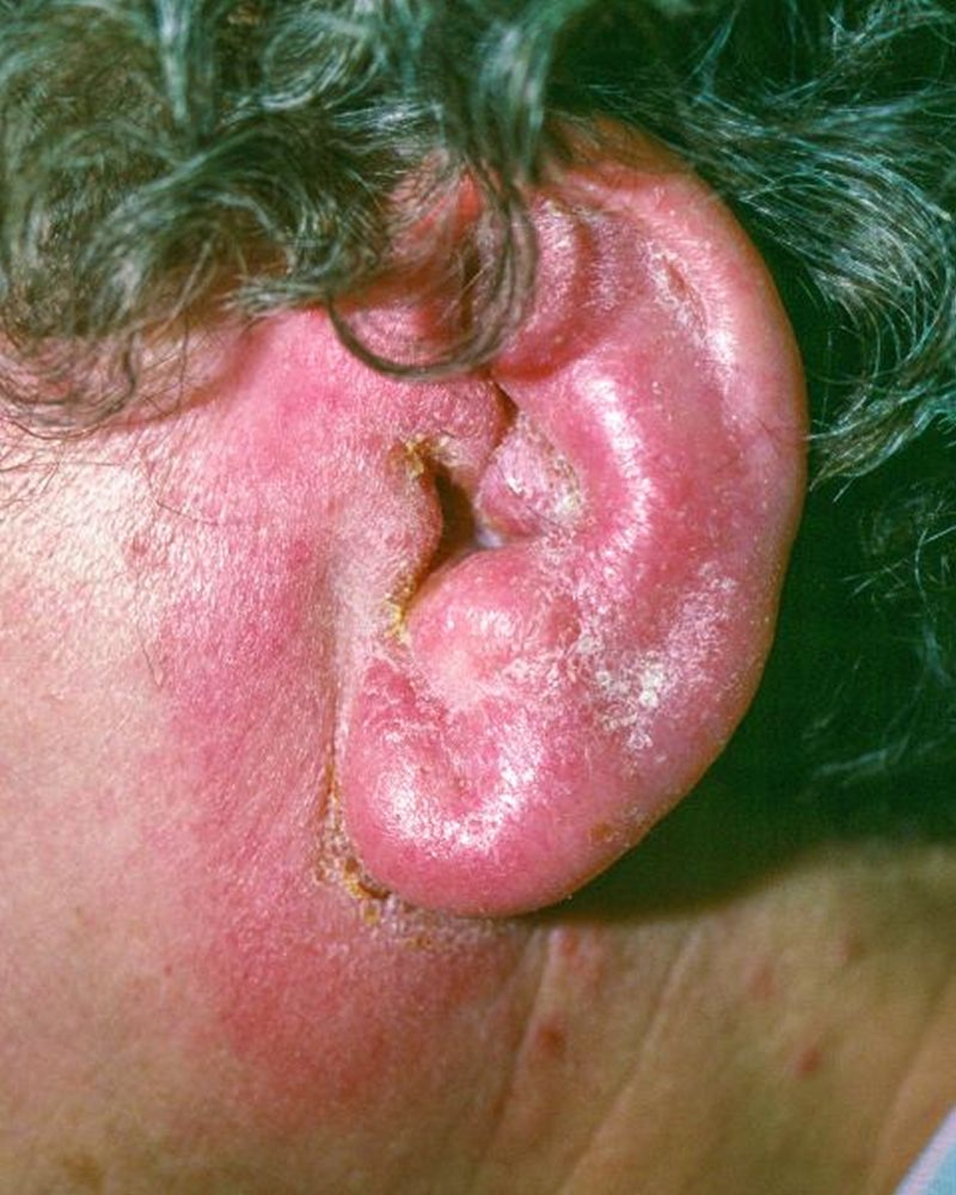 Otitis Externa