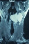 Combined Laryngocele