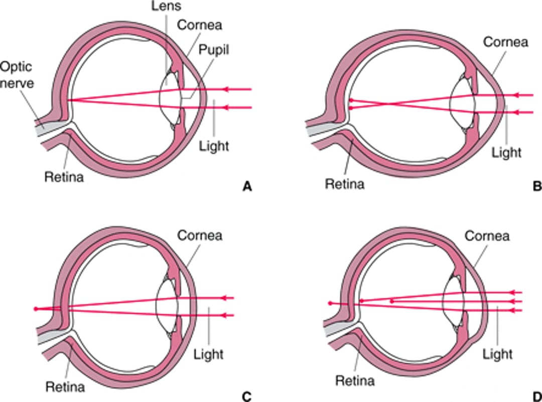 Errors of Refraction
