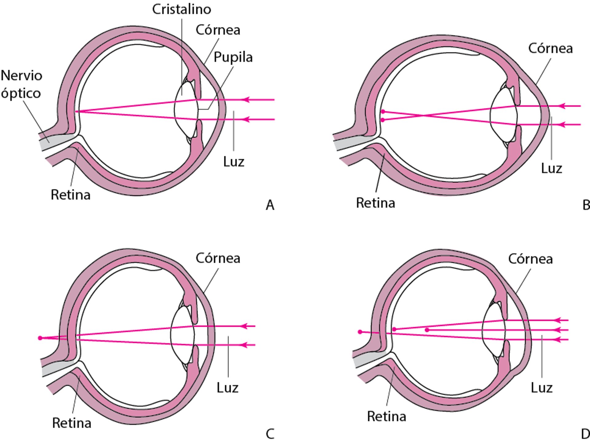 Defectos de la refracción
