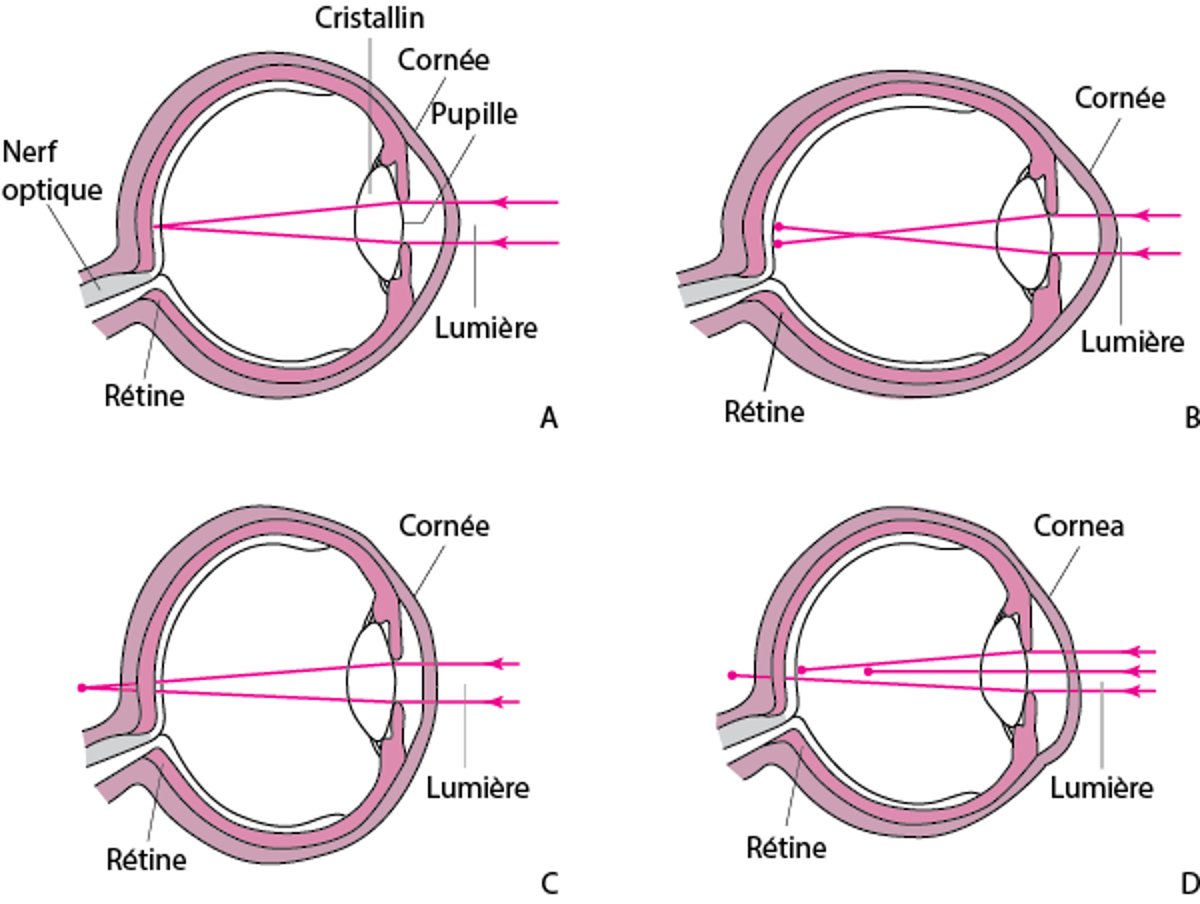 Troubles de la réfraction