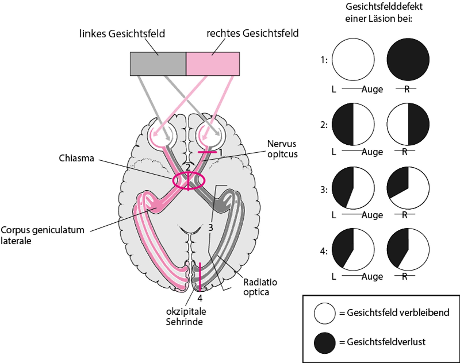 Höhere Sehbahnen - Läsionsstellen und entsprechende Gesichtsfelddefekte