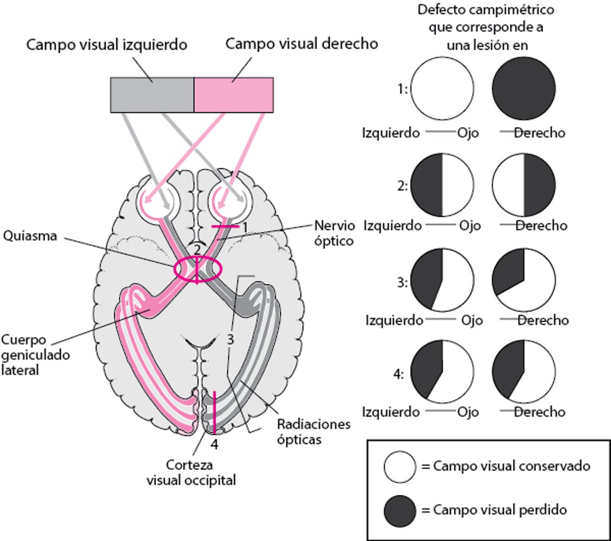 Tracto visual superior –sitios de lesión y defectos campimétricos correspondientes