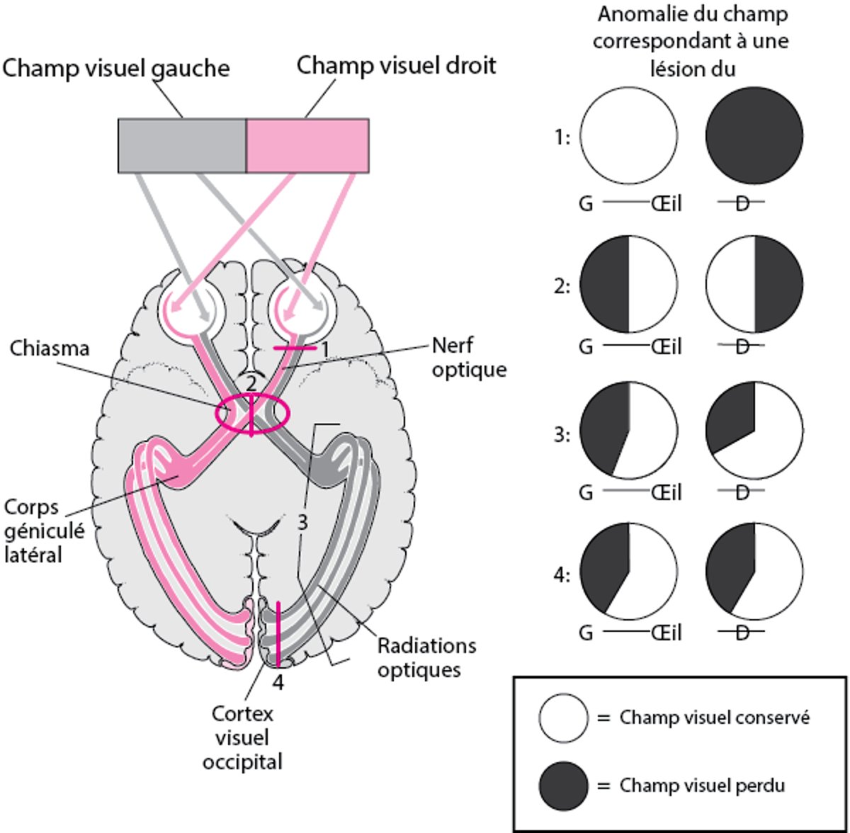 Voies visuelles supérieures, localisation des lésions et déficits correspondants du champ visuel