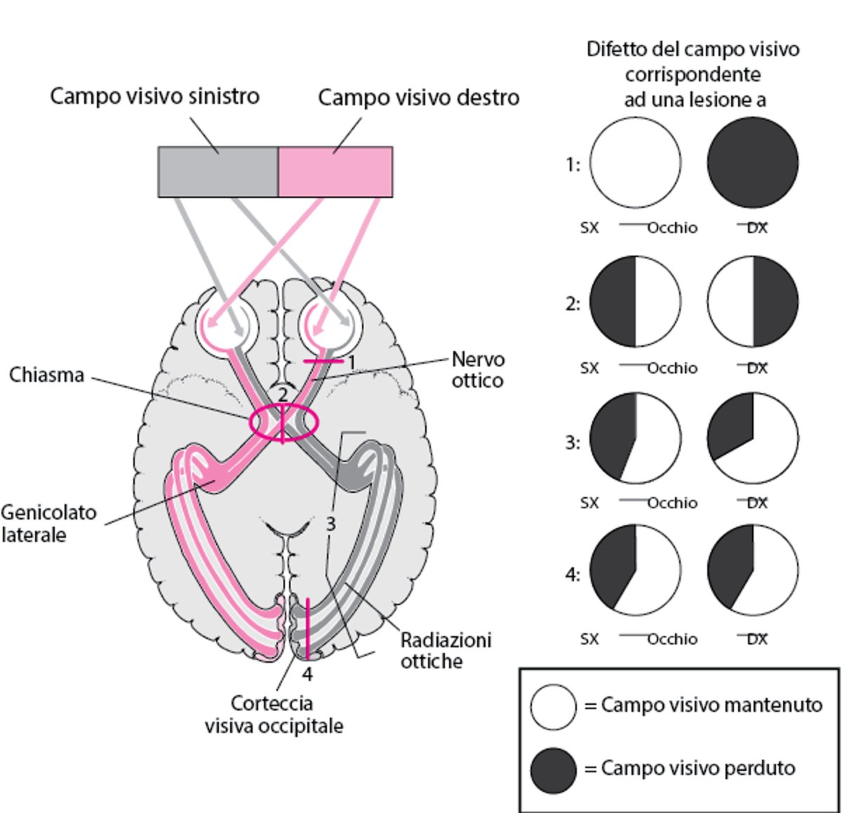 Sedi di lesione delle vie ottiche superiori e deficit corrispondenti del campo visivo