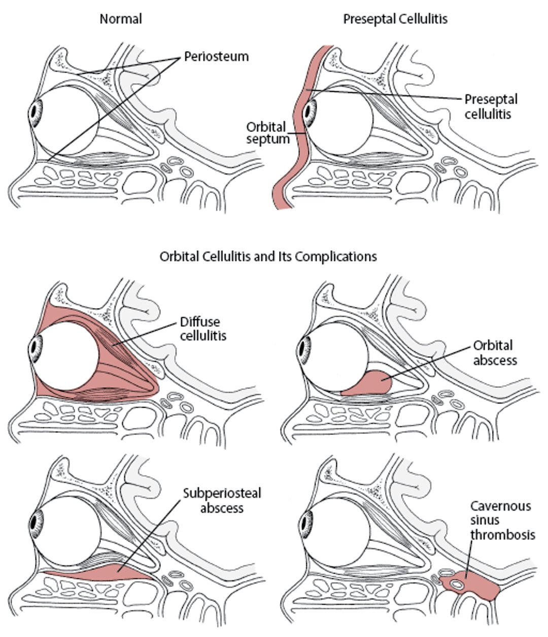 Preseptal and Orbital Cellulitis