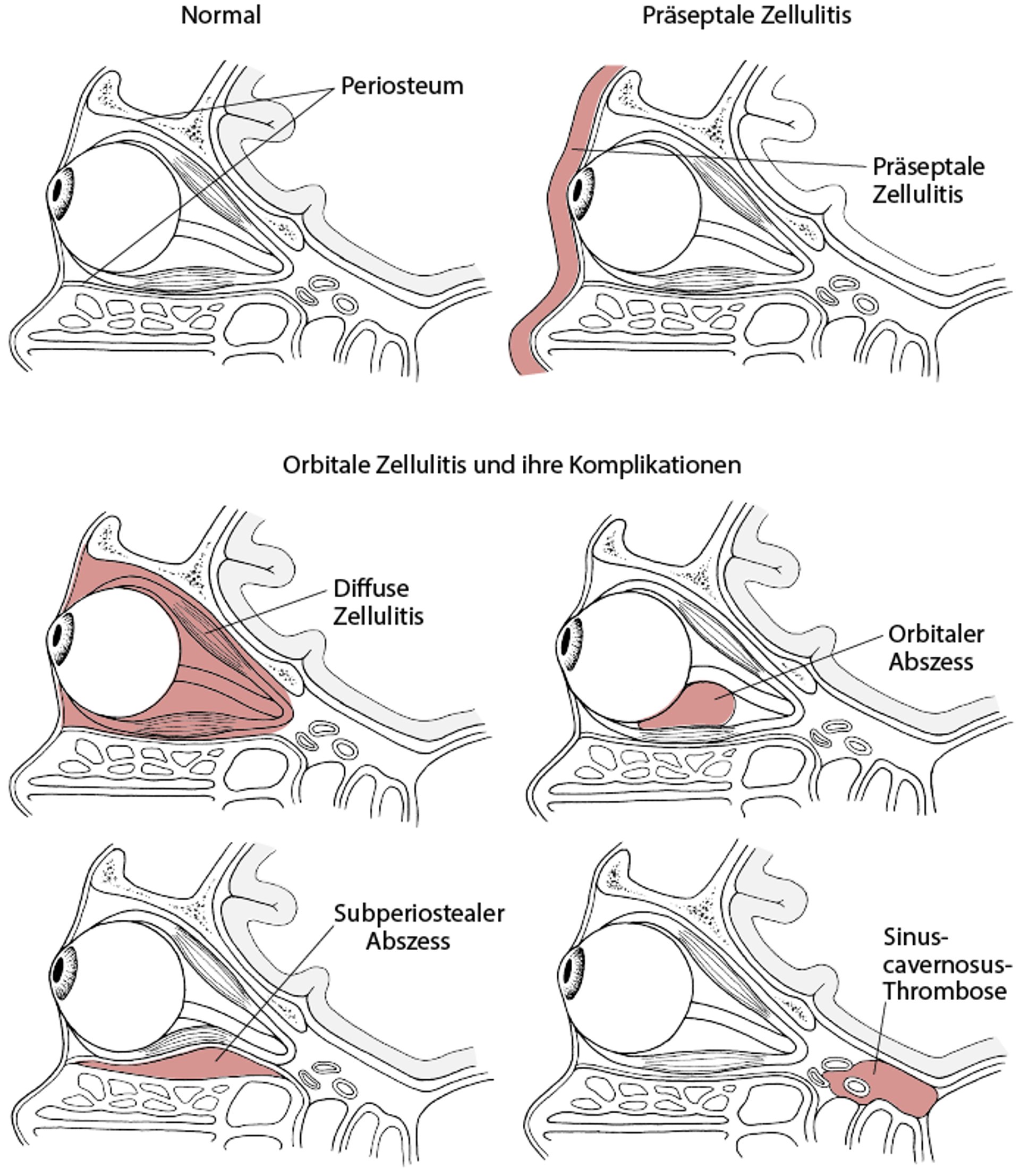 Periorbital- und Orbitalphlegmone