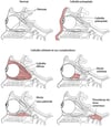 Cellulite préseptale et orbitaire