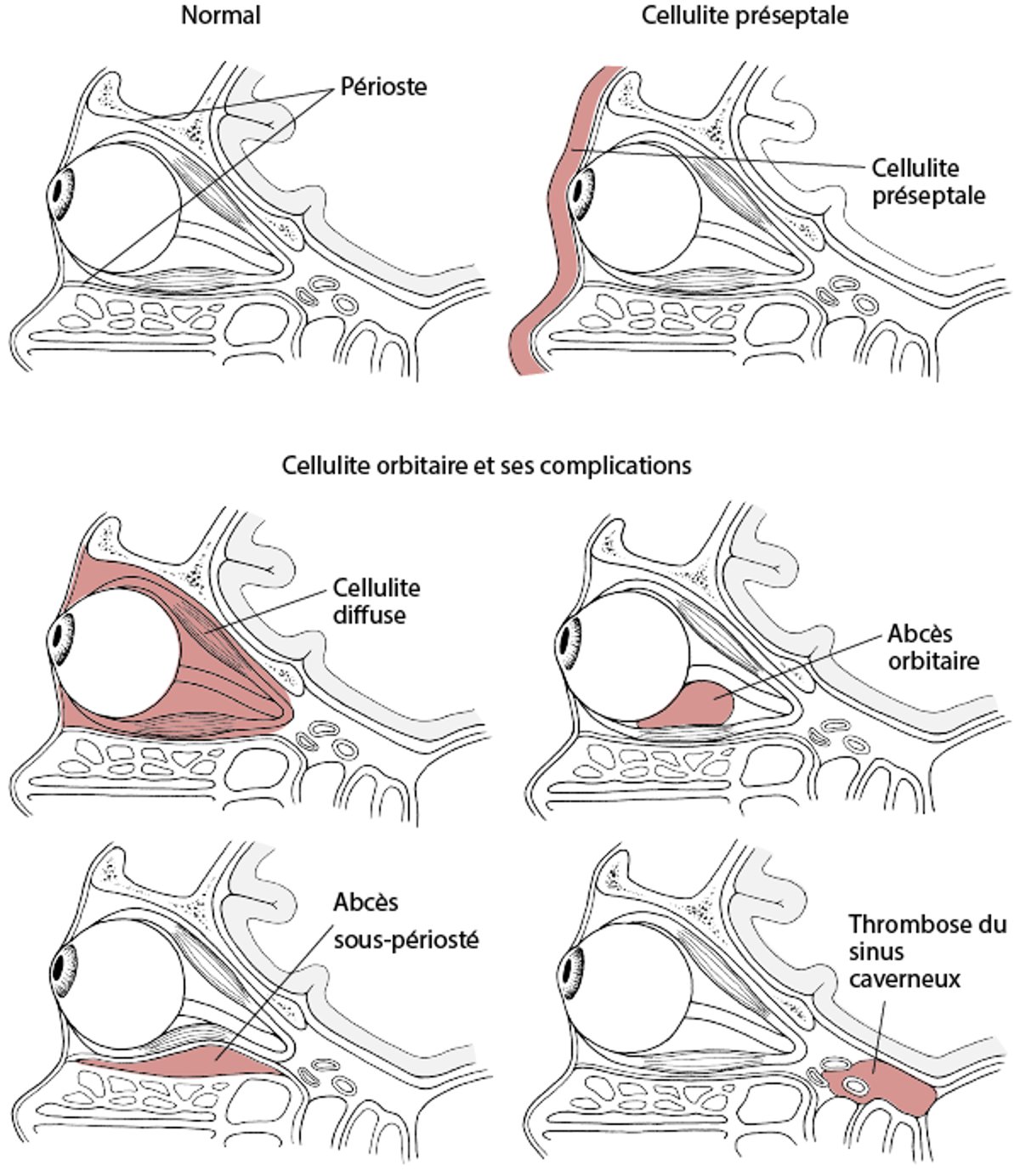 Cellulite préseptale et orbitaire