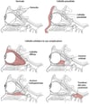 Cellulite presettale e orbitaria