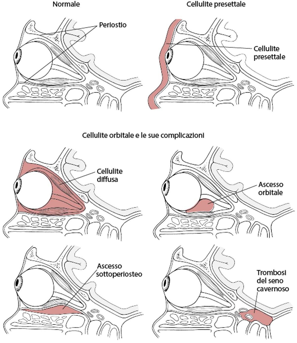 Cellulite presettale e orbitaria
